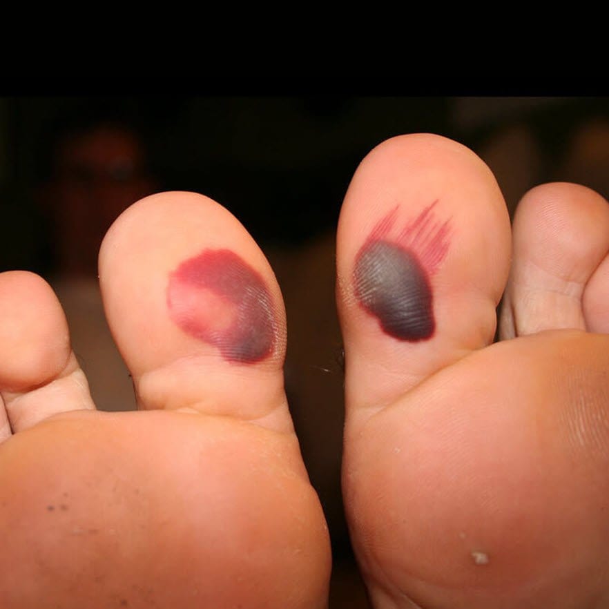 12 Blood Blister Remedies For Quick Healing