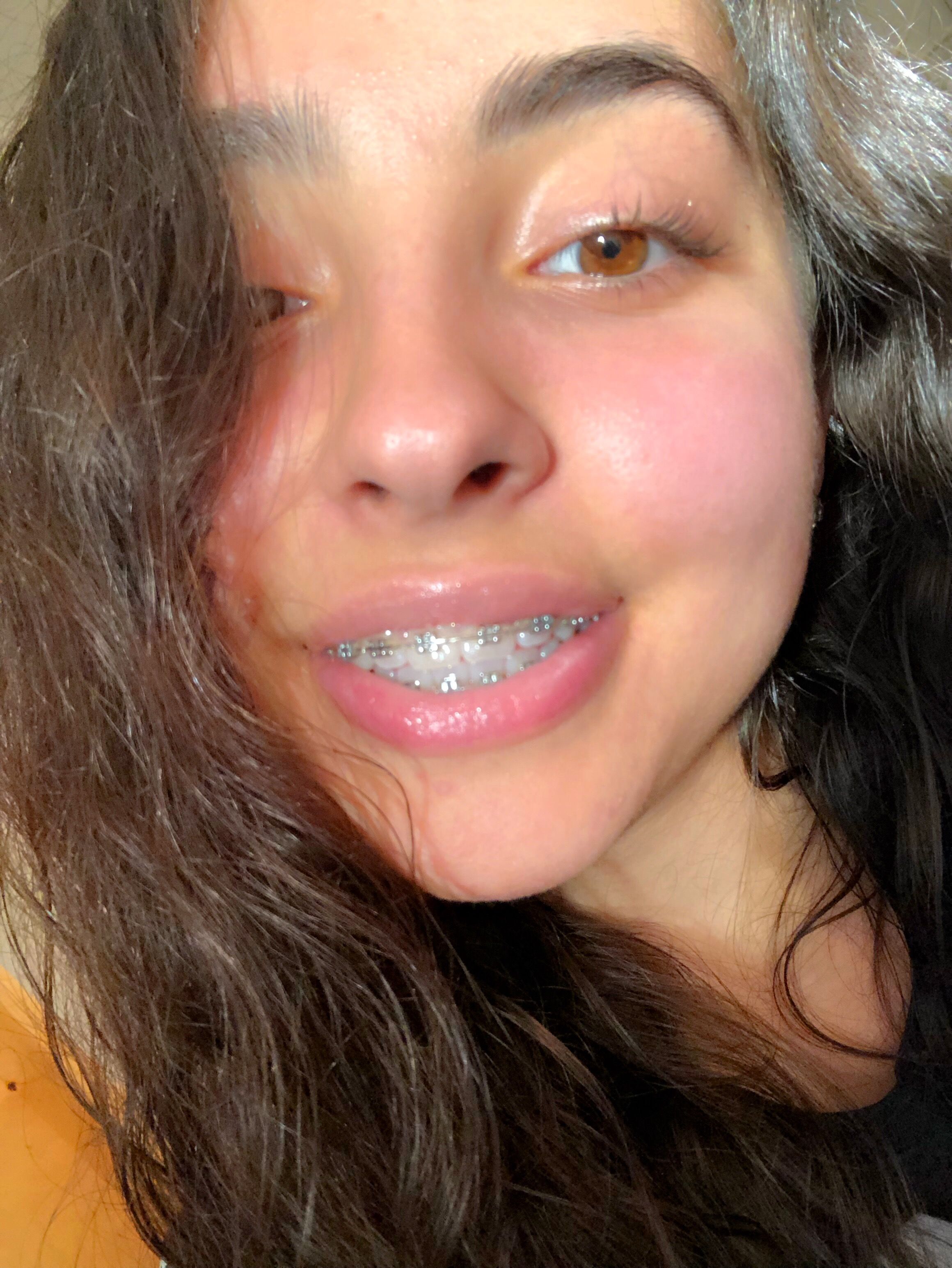 12 Braces Tips For Perfect Smiles