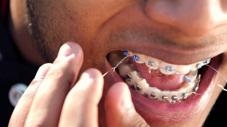 12 Braces Wire Snapped Fixes For Fast Relief