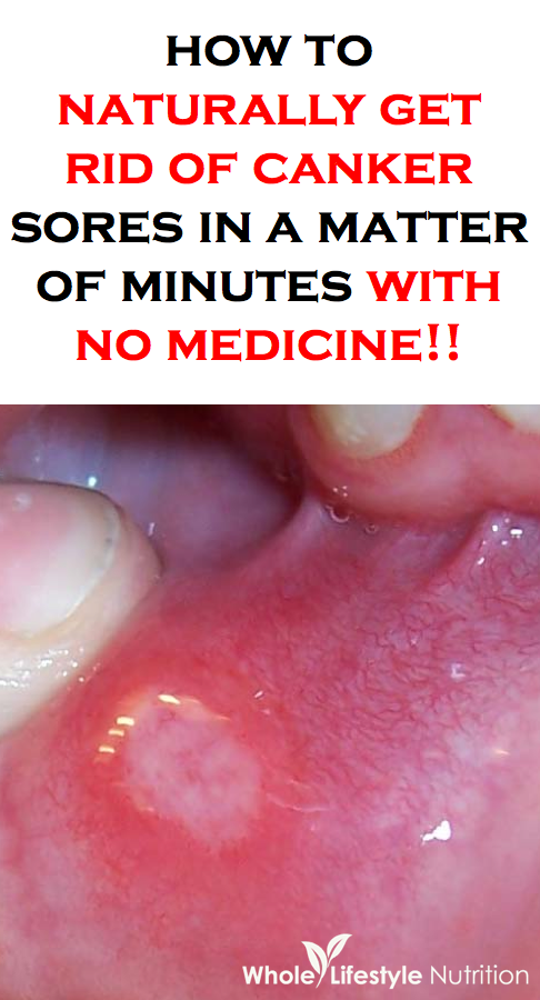 12 Canker Sore Remedies For Pregnant Women