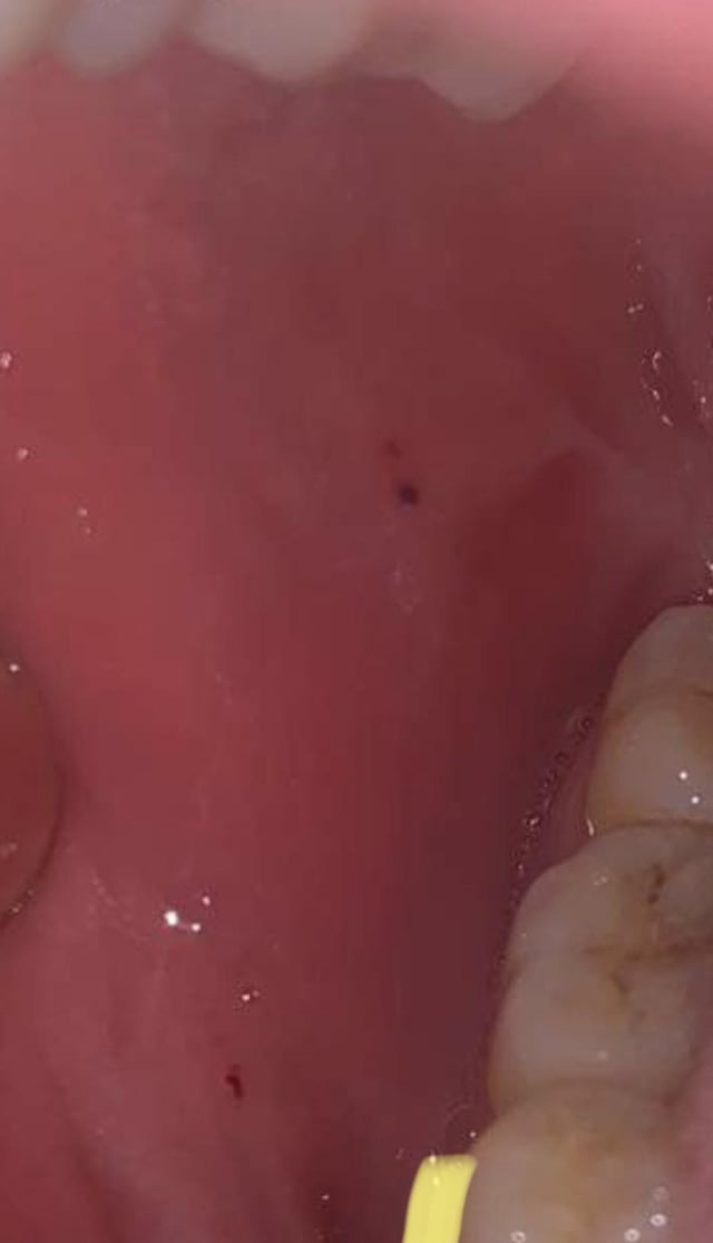 12+ Causes Of Black Dot Inside Mouth Cheek Explained