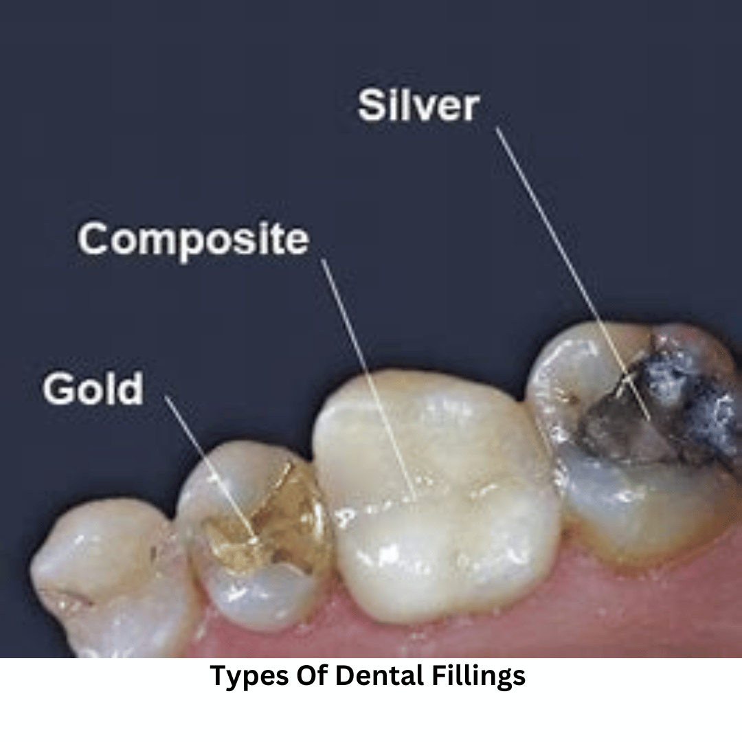 12+ Cavity Filling Tips To Reduce Swelling