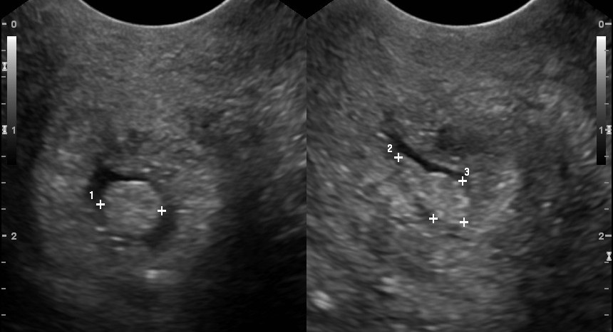 12 Cervical Polyp Images For Accurate Diagnosis 12 Cervical Polyp Images For Accurate Diagnosis