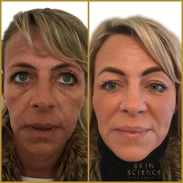 12+ Cheek Line Treatments For Smoother Skin