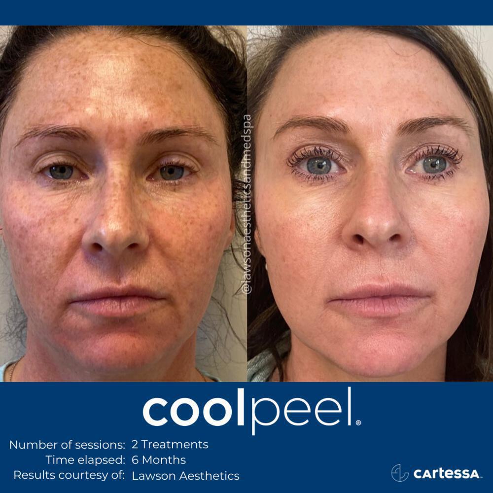 12+ Co2 Laser Treatments To Save You Money