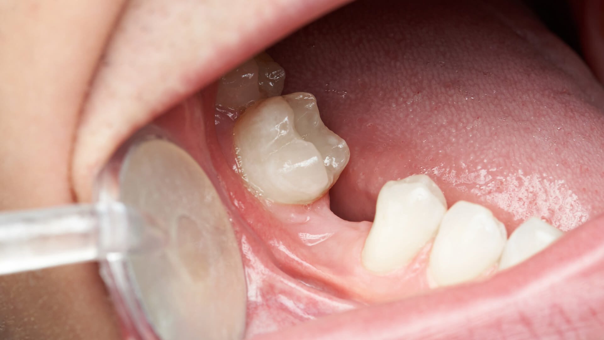 12+ Cost Options To Fix All Teeth
