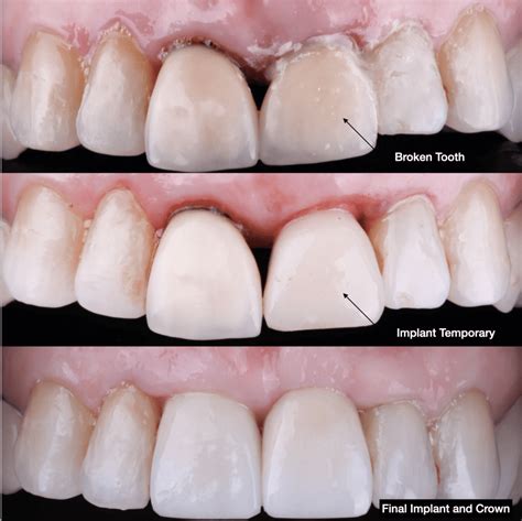 12 Dental Cap Front Tooth Solutions