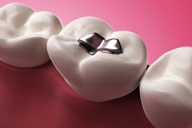 12 Filling Falls Out Solutions To Save Your Smile