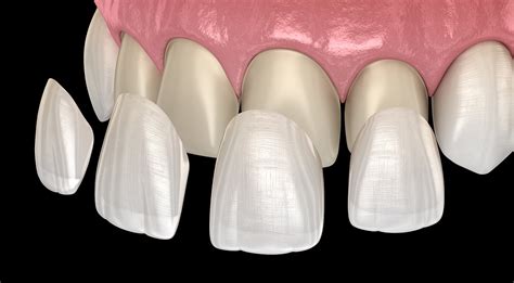 12+ Get Veneers Near Me Tips For Affordable Care