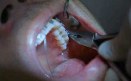 12+ Gold Metal Braces Secrets For Faster Results