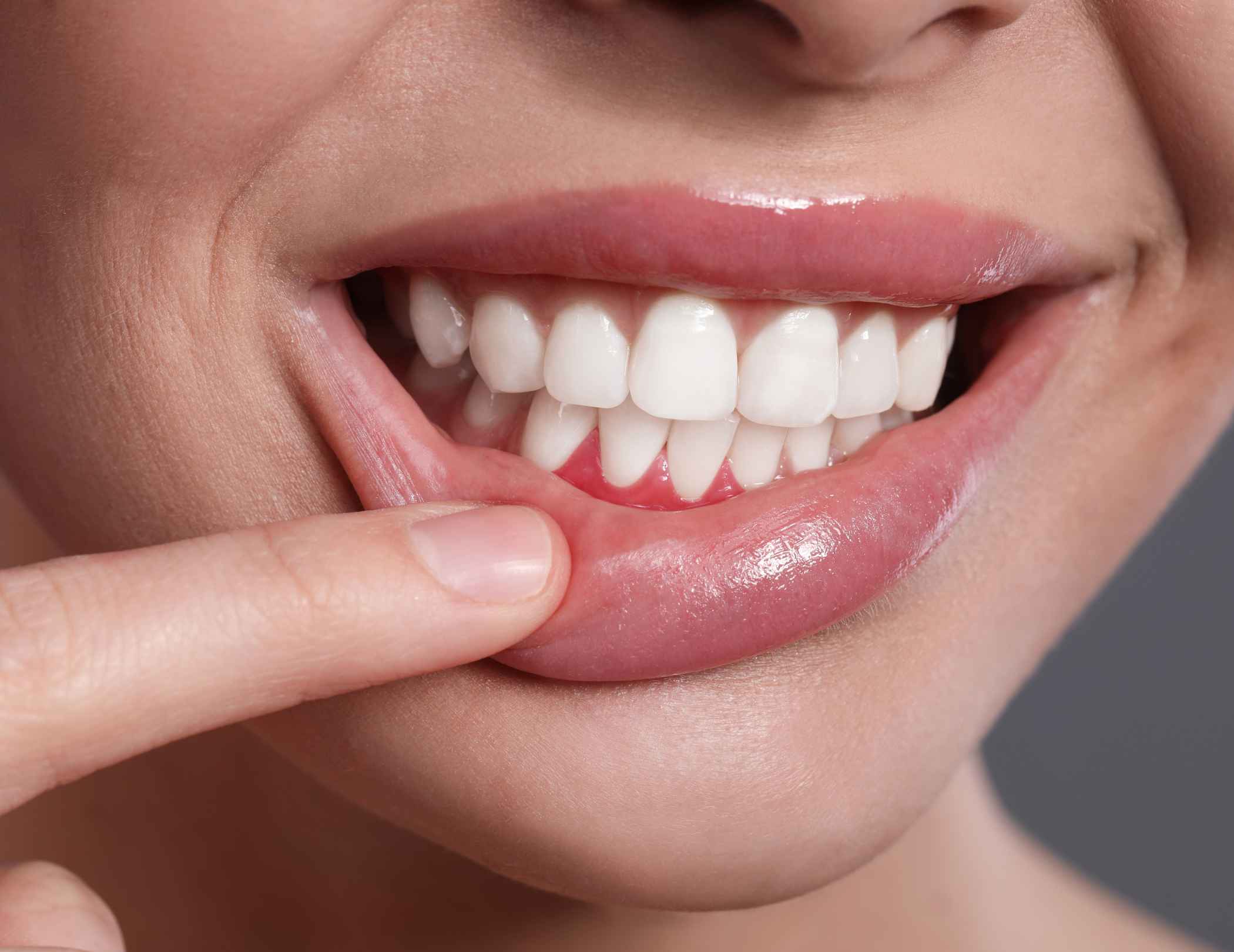 12+ Gum Hematoma Treatments To Reduce Swelling