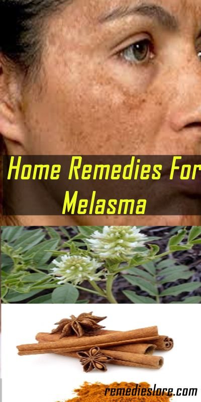 12+ Home Remedies To Remove Melasma Mustache
