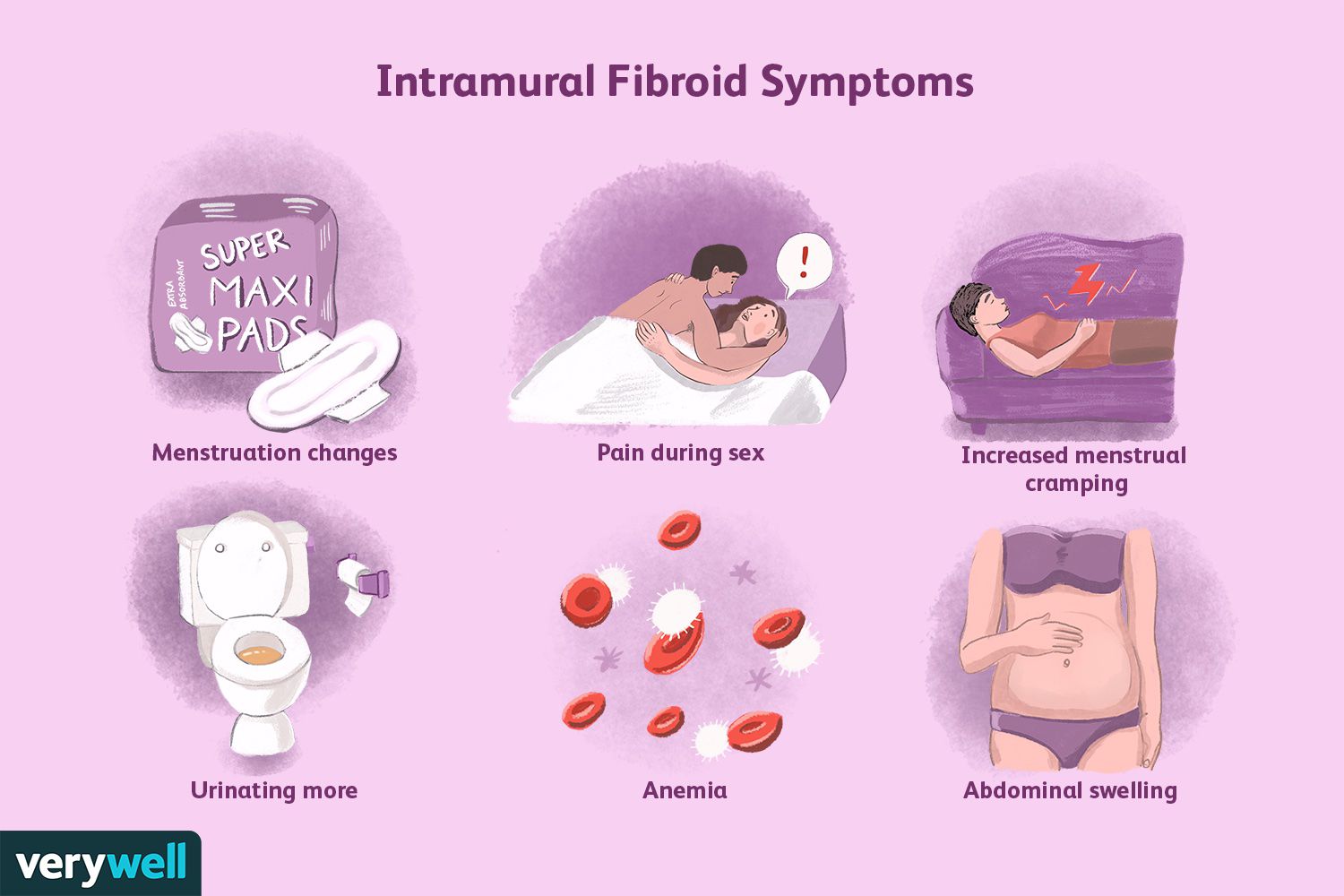 12+ Intramural Hematoma Aorta Symptoms To Know