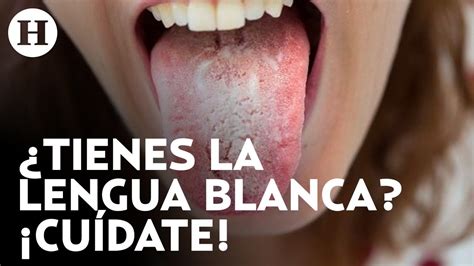 12+ Lengua Blanca Causes To Know Fast
