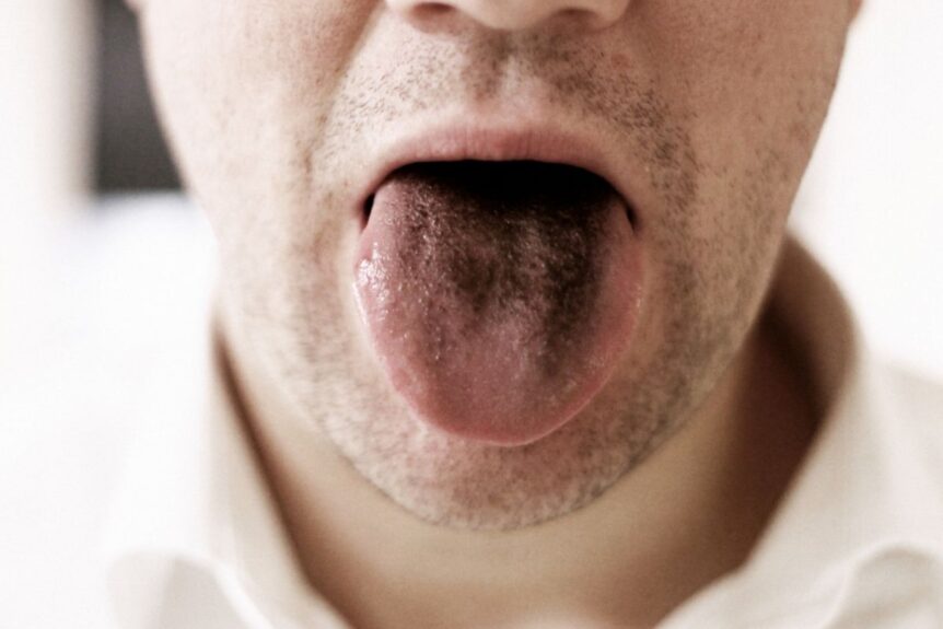 12 Lengua Negra Causas Revealed
