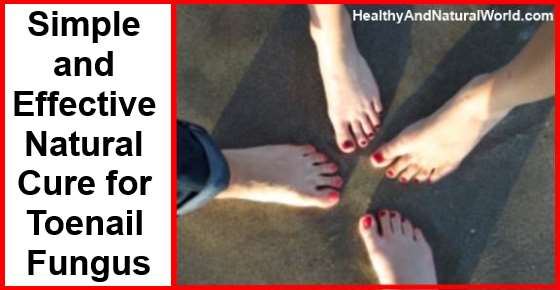 12+ Natural Herbs To Cure Toenail Fungus
