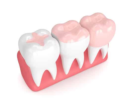 12+ Onlay Benefits To Restore Perfect Teeth