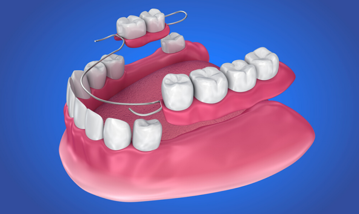 12+ Partial Dentures With Implants For Perfect Smile