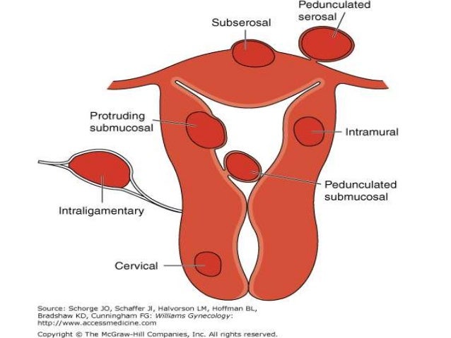 12 Pelvic Mass Symptoms To Identify Quickly