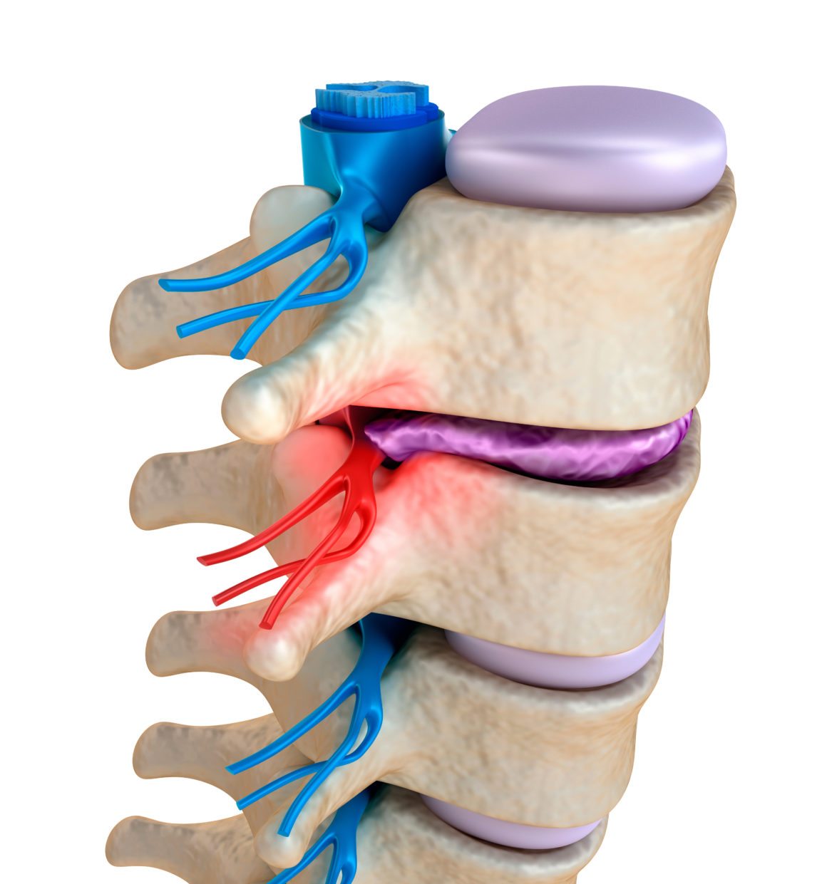 12+ Pinched Nerve Symptoms To Identify Fast