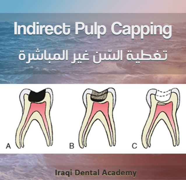 12+ Pulp Cap Procedures For Reduced Pain