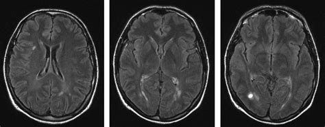 12 Radiologic Isolated Syndrome Symptoms To Recognize