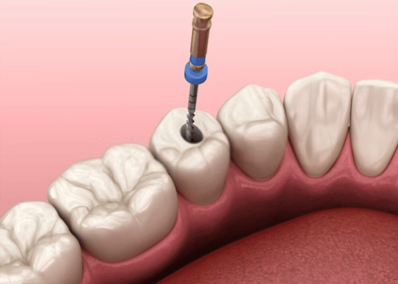 12+ Root Canal Secrets For Faster Recovery