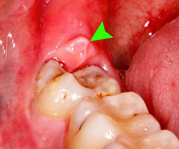 12+ Swollen Gums Solutions To Ease Pain