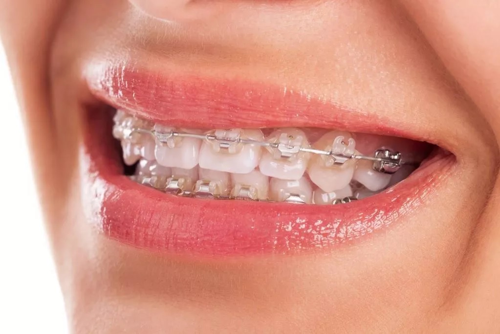 12+ Teeth Braces Options That Fit Any Budget