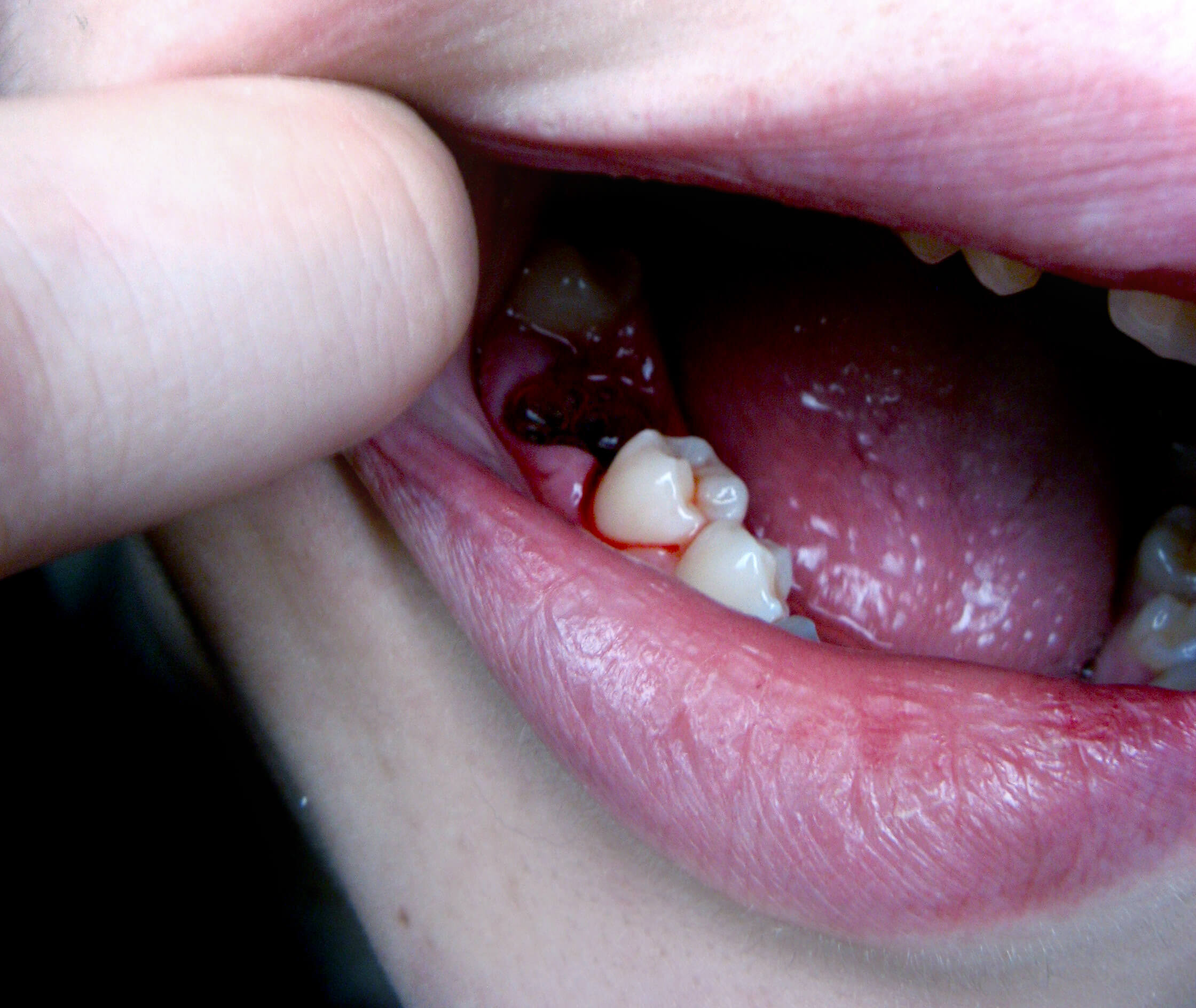 12 Tooth Pulling Tips Near Me For Easy Recovery