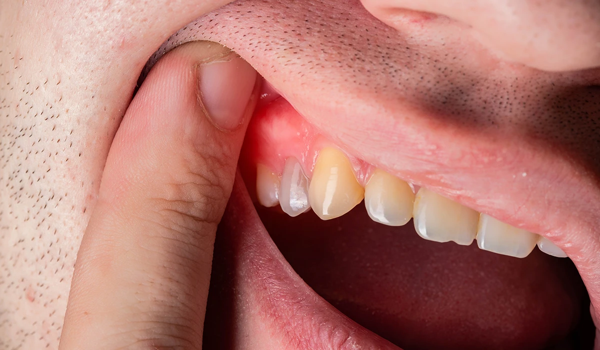 12+ Urgent Care Tips For Dental Abscess Near Me