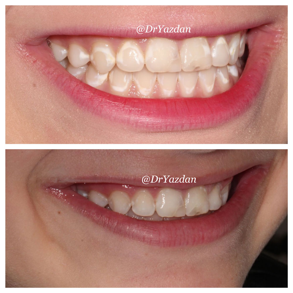 12+ Whitening Secrets To Remove Teeth Spots Forever