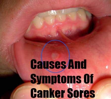22 Common Causes And Symptoms Of Canker Sores Gum Sores Canker Sore 22 Common Causes And Symptoms Of Canker Sores Gum Sores Canker Sore