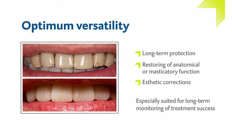 7+ Bridge Crown Secrets For Long Lasting Teeth