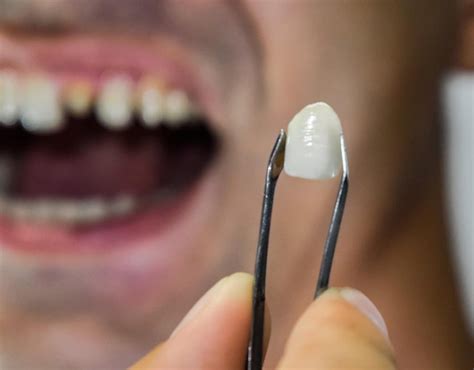 7 Cavity Filling Secrets To Reduce Pain
