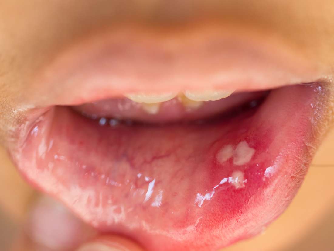 7 Hpv Wart Symptoms Explained