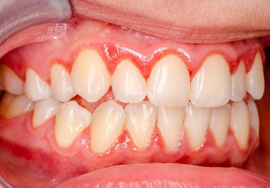 7 Itchy Gums Causes To Know For Better Health