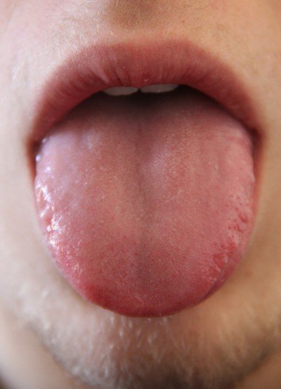 7 Tongue Sore Solutions To Ease Discomfort