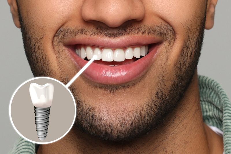 8 Dental Implants Secrets For Natural Look