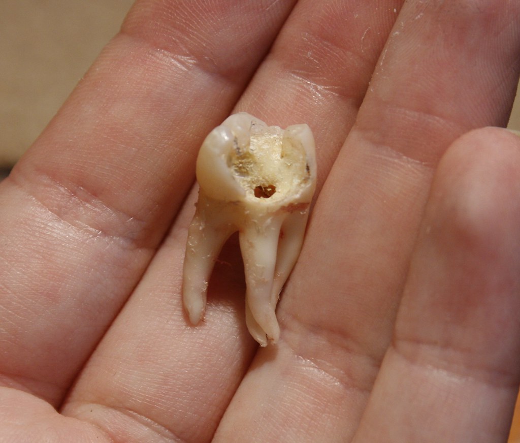 8 Jaw Ache Solutions After Filling