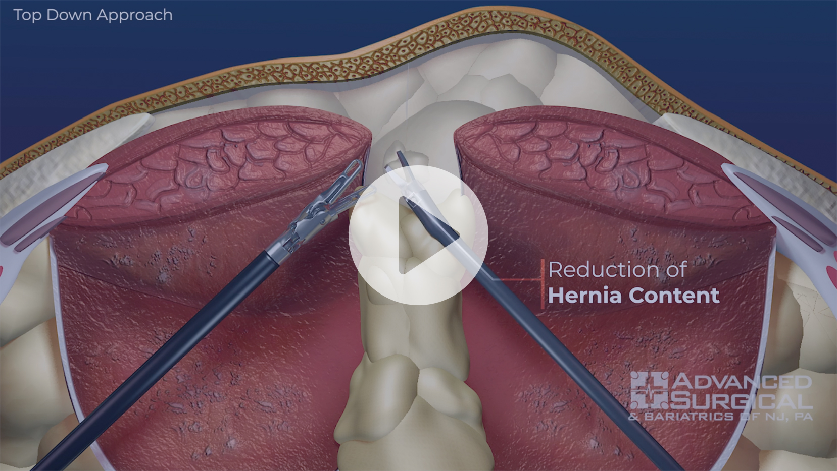 8 Surgery Incision Tips To Reduce Bleeding