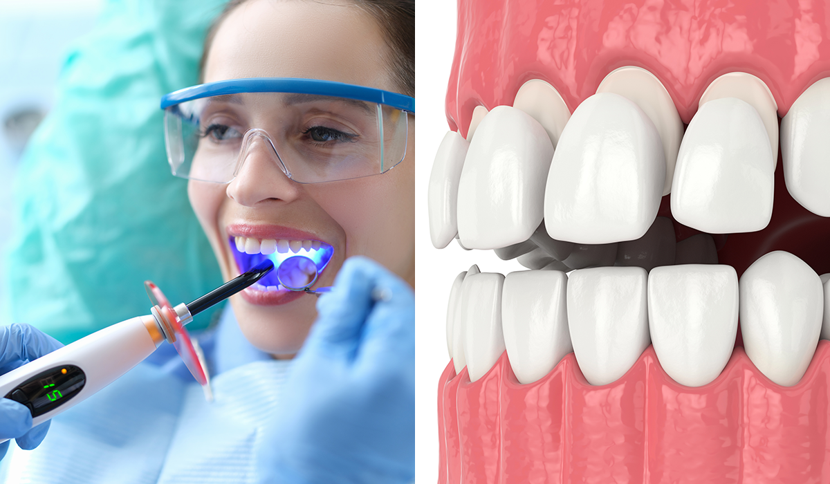 8 Veneers Pros That Improve Smiles