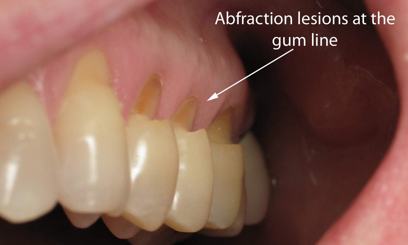 Abfractions On Teeth Abfractions On Teeth