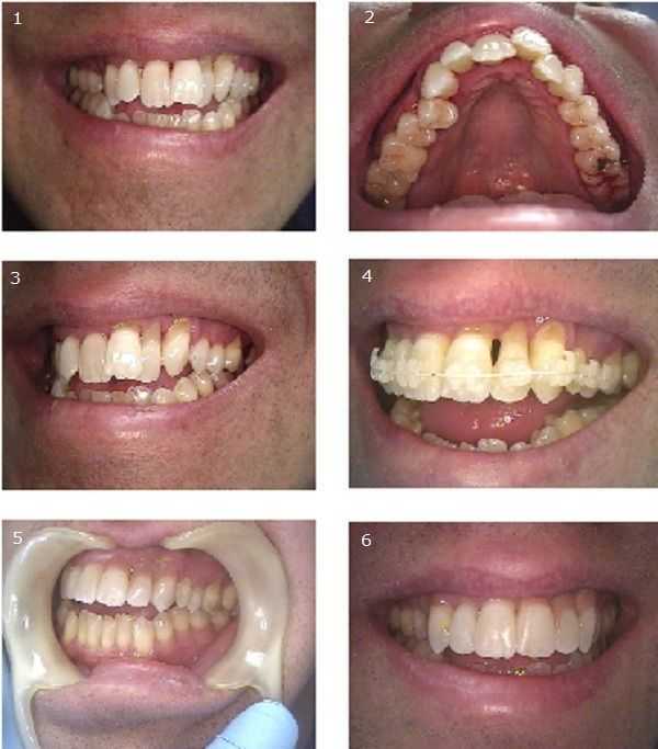 Abrasion On Gums