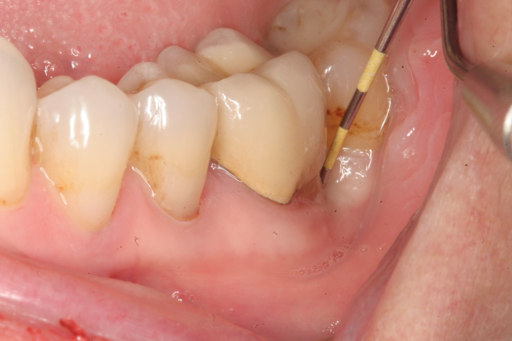 Abscessed Tooth After Extraction