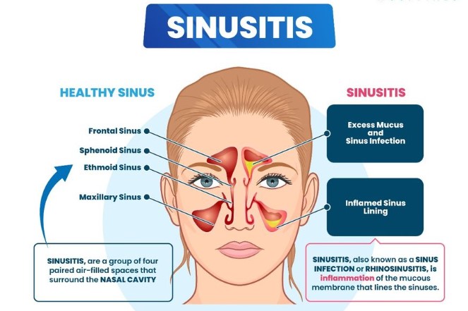 Acute Sinusitis Guide Causes Symptoms And Treatment Options Acute Sinusitis Guide Causes Symptoms And Treatment Options