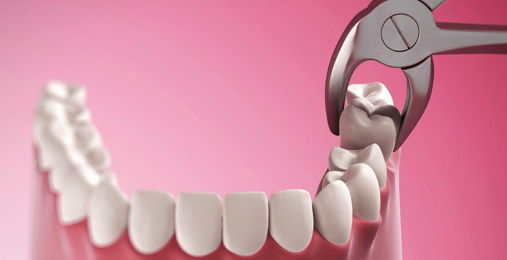 Affordable Tooth Removal