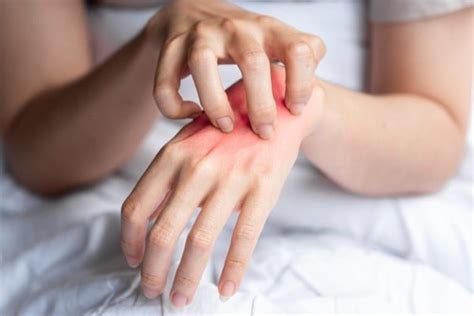 Alergia Emocional Na Mão