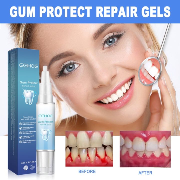 Antibiotic Gel Gum Disease