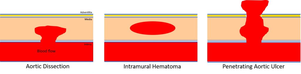 Aortic Ulcer Symptoms